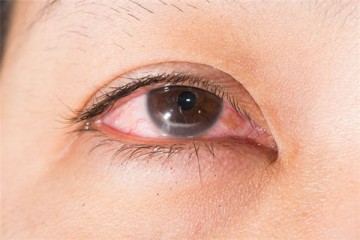 Đau mắt đỏ khi bơi | Nguyên nhân, dấu hiệu và cách phòng tránh!